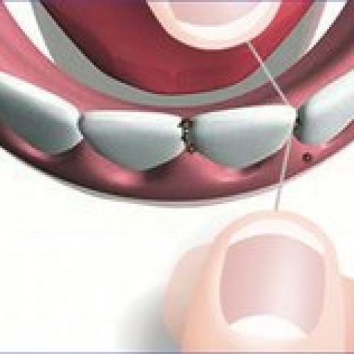 prodsec 156164